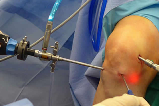 artroscopia de rodilla quito